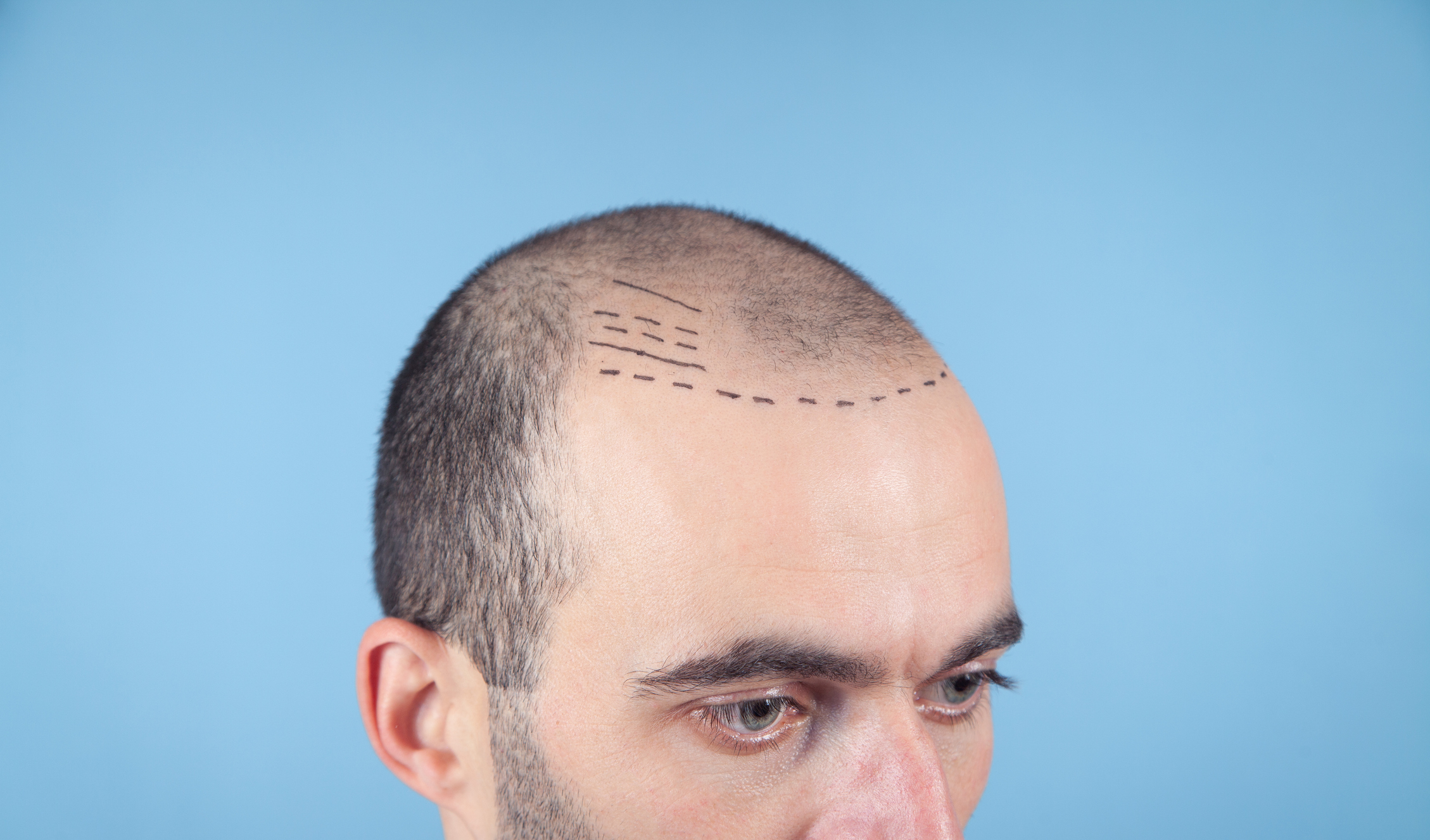 Man gets ready for a hair transplant with scalp markings that indicate hair transplant location.