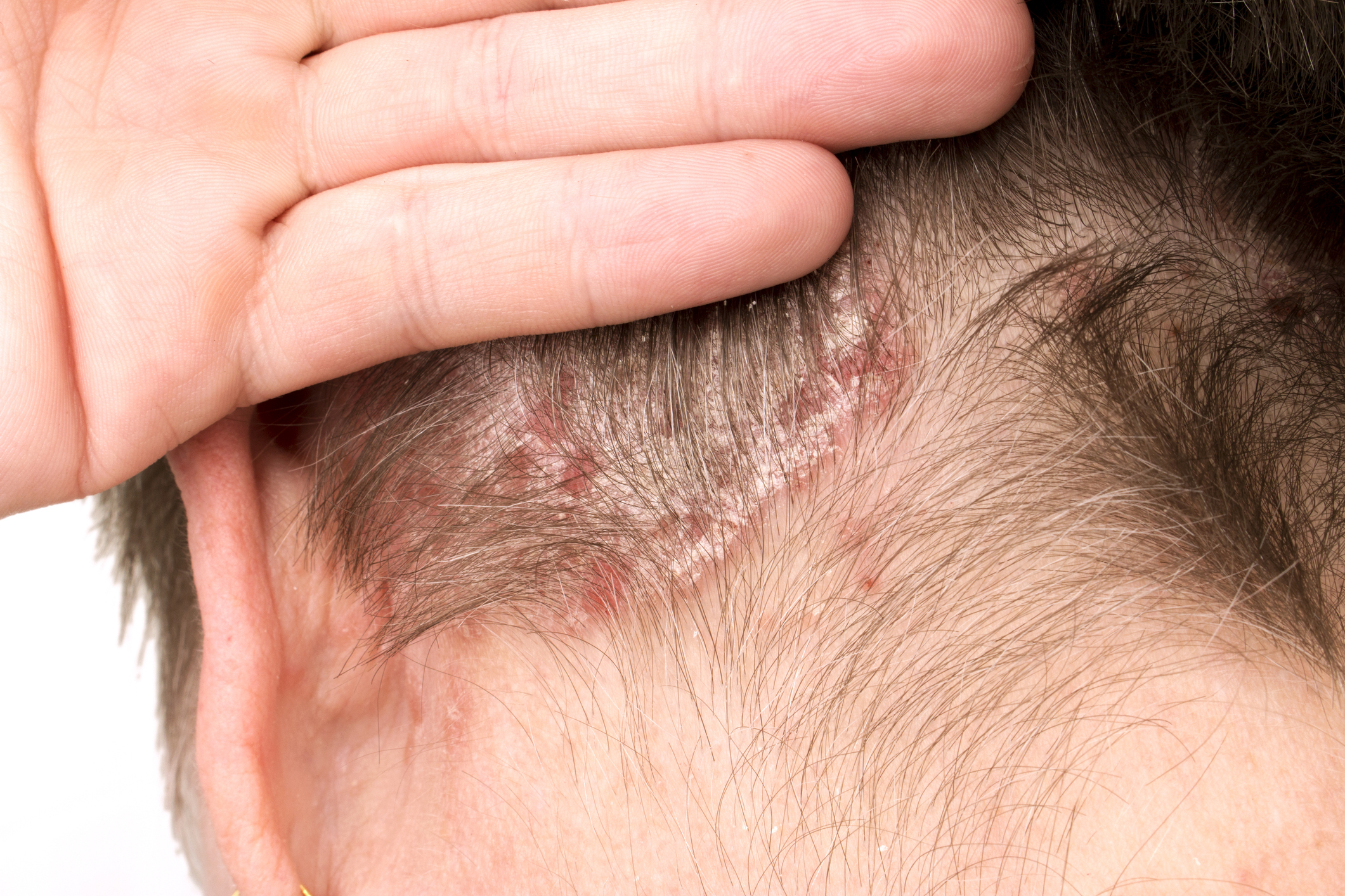 Man pushes hair up to show scalp psoriasis at the nape.