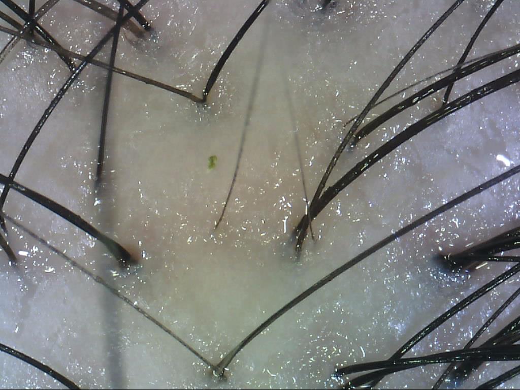 juliArt hair loss on oily scalp