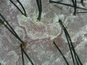 Psoriasis with Oily Scalp