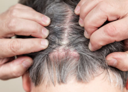 Psoriasis with oily scalp | juliArt Psoriasis with oily scalp | juliArt