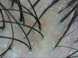 juliArt product review_Iris_Seborrheic Dermatitis
